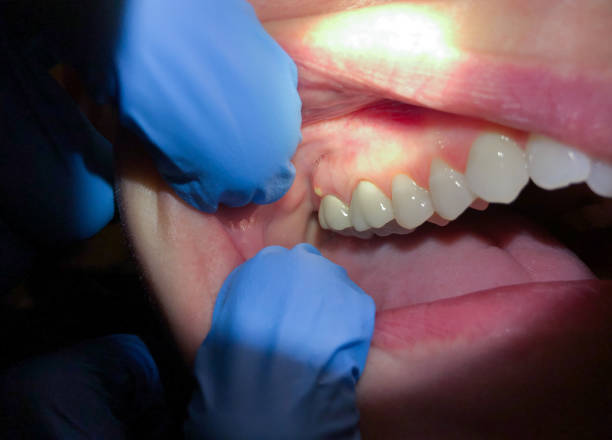 Best Emergency Wisdom Tooth Extraction in Nokomis, FL